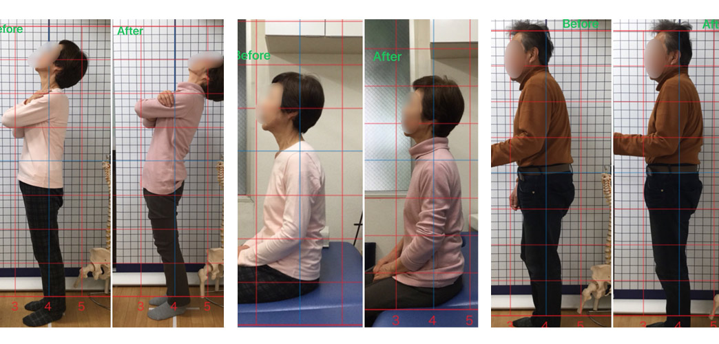 患者さまの治療・施術ビフォーアフター比較写真
