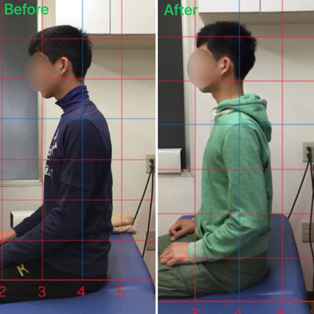 猫背の矯正ならファースト整骨院
