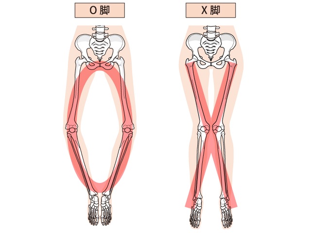 「O脚」「X脚」にお悩みの方